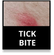 Tick Bite