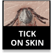Tick On Skin